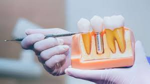 Ultimate Dental Implants Guide